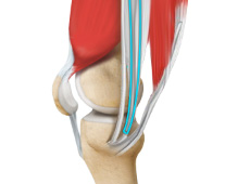 ACL Reconstruction Procedure – Hamstring Tendon