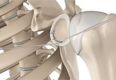 Arthroscopic Bankart Repair