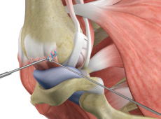 Arthroscopic Rotator Cuff Repair
