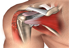 Biceps Tendonitis