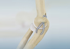 Knee Ligament Reconstruction