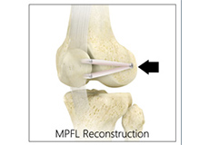 Medial Patellofemoral Ligament Reconstruction