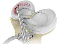 Meniscus Repairs