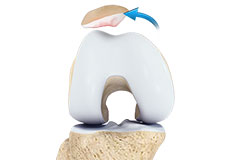Patellar Instability