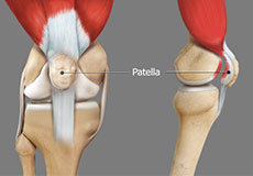 Patellofemoral pain syndrome